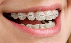 clear braces in schneckville pa cherry orthodontics