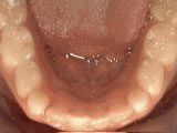 Common Orthodontic Issues