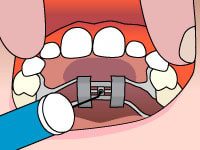 palatal expander in Bethlehem Cherry Orthodontics, Dr. William Cherry DMD, Orthodontist in Bethlehem Pennsylvania, Orthodontist in Schnecksville Pennsylvania, orthodontic treatments, spark clear aligners, surgical orthodontics, tads, types of braces, virtual smile assessment, common orthodontic issues bethlehem & schnecksville, clear aligners, damon smile, orthodontics for Adults, orthodontics for teens, orthodontics for children, Invisalign, Itero Digital scans, dentofacial orthopedics, mouthguards, retainers, emergency orthodontic care, palatal expanders, two phase treatment, invisalign smileview, early orthodontic treatment, orthodontics in bethlehem,orthodontics in schnecksville, Dr. William Cherry, DMD Family orthodontist, BETHLEHEM OFFICE (484) 893-5000,SCHNECKSVILLE OFFICE (610) 769-5100,NEW PATIENTS (484) 897-6088