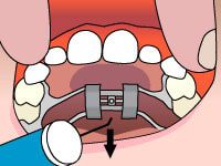 palatal expander in Bethlehem Cherry Orthodontics, Dr. William Cherry DMD, Orthodontist in Bethlehem Pennsylvania, Orthodontist in Schnecksville Pennsylvania, orthodontic treatments, spark clear aligners, surgical orthodontics, tads, types of braces, virtual smile assessment, common orthodontic issues bethlehem & schnecksville, clear aligners, damon smile, orthodontics for Adults, orthodontics for teens, orthodontics for children, Invisalign, Itero Digital scans, dentofacial orthopedics, mouthguards, retainers, emergency orthodontic care, palatal expanders, two phase treatment, invisalign smileview, early orthodontic treatment, orthodontics in bethlehem,orthodontics in schnecksville, Dr. William Cherry, DMD Family orthodontist, BETHLEHEM OFFICE (484) 893-5000,SCHNECKSVILLE OFFICE (610) 769-5100,NEW PATIENTS (484) 897-6088