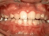 Common Orthodontic Issues