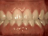 Common Orthodontic Issues