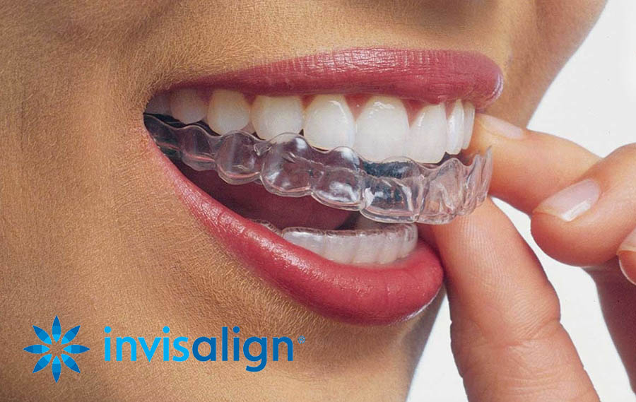 Preview Your New Smile With Invisalign® SmileView™