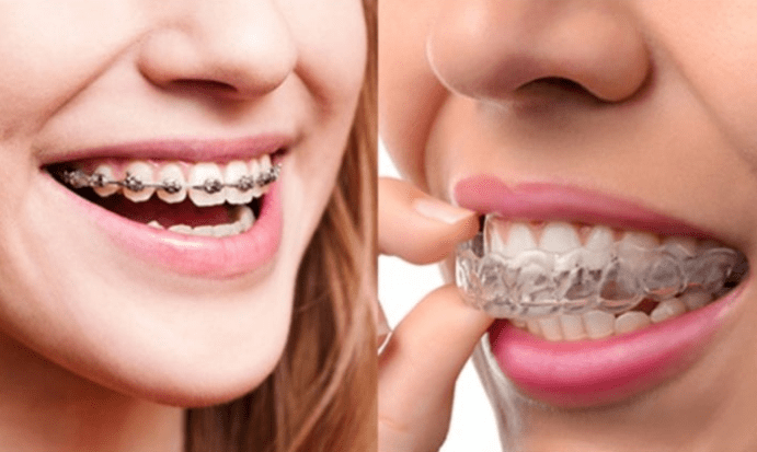 Invisalign Vs Braces Which Is Better For You Bethlehem Pa