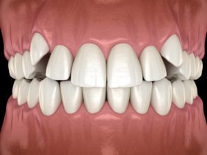 impacted canine