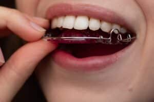 Orthodontic Retainers Bethlehem