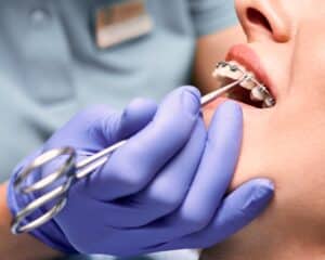 Close-up of orthodontist’s hand placing an elastic rubber band on braces in Bethlehem.