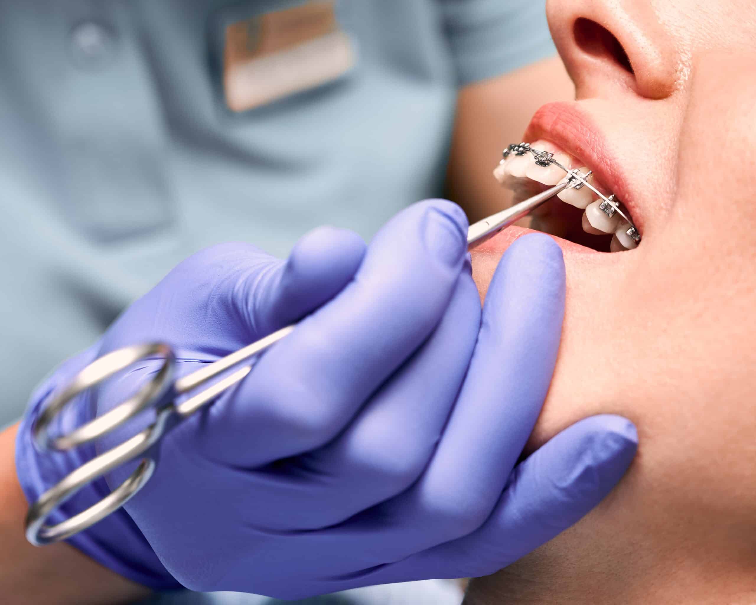 Close-up of orthodontist’s hand placing an elastic rubber band on braces in Bethlehem.