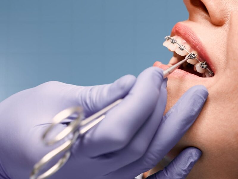 Orthodontic Treatments Bethlehem