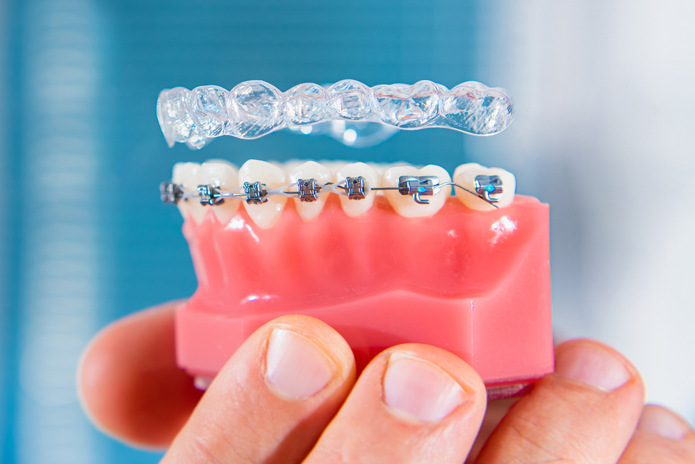 Invisalign vs Braces Bethlehem