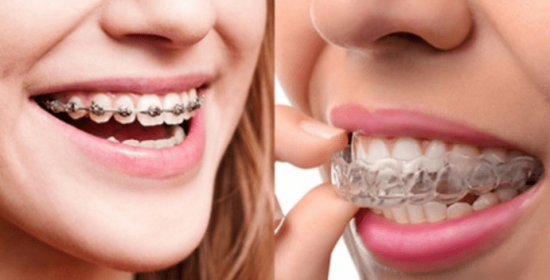 Invisalign vs. Braces in Lehigh Valley PA Invisalign vs. Braces in Lehigh Valley PA